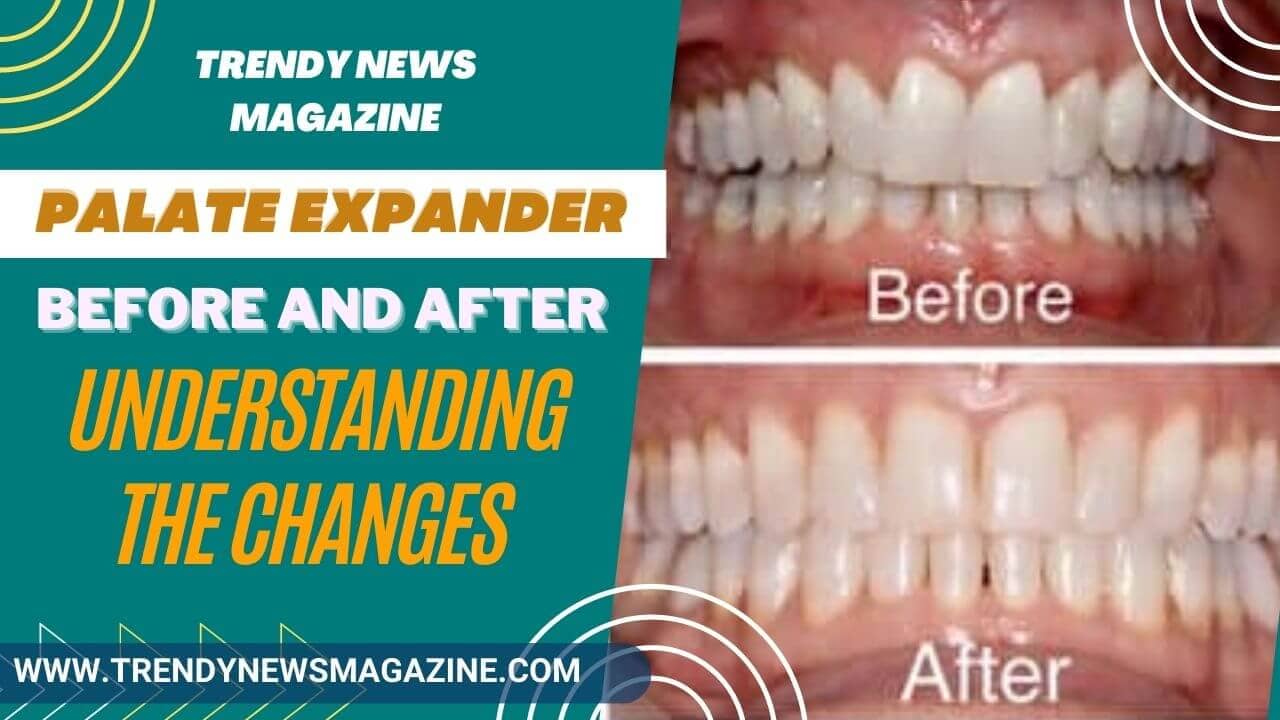 palate expander before and after