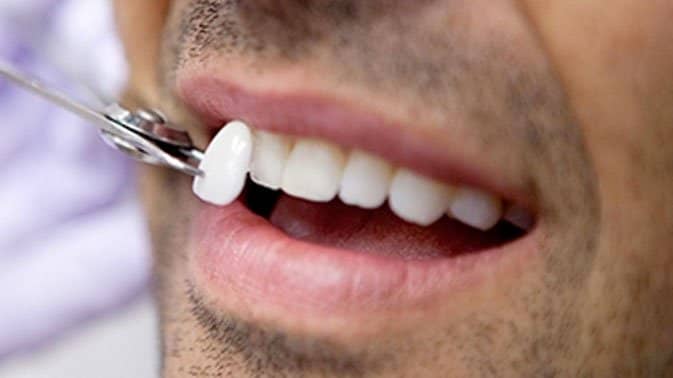 Get a Hollywood Smile With Dental Veneers Dubai